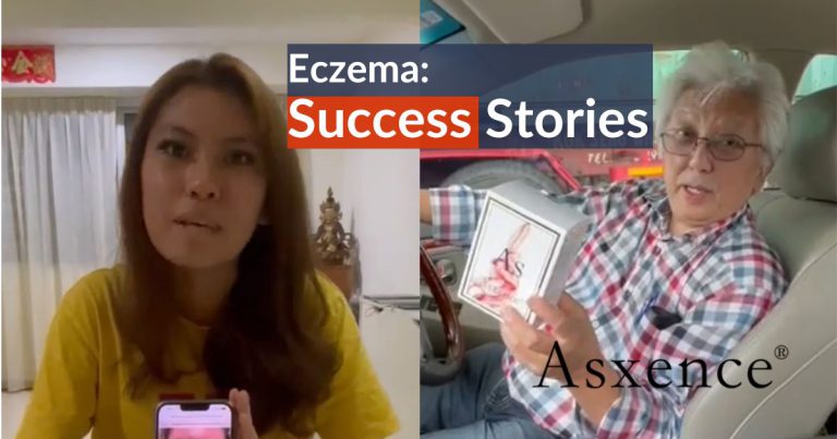 Eczema Success Stories